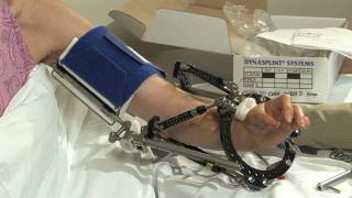 External Fixation and Elbow Range of Motion by Dynasplint®