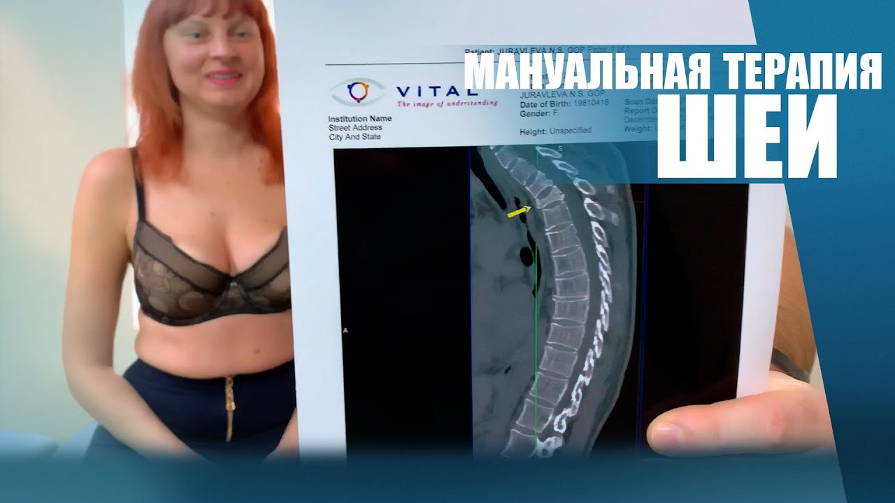 Мануальная терапия шеи после компрессионного перелома D2 и взрывного D3 ...