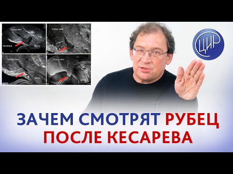 Рубец на матке после кесарева сечения. Что на самом деле смотрит врач когда оценивает рубец на матке