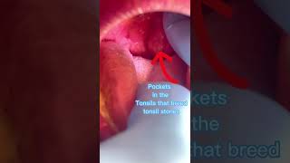 Tonsils stones the cause of bad breath. dinodentalkampala dentist
