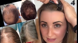 علاج تساقط الشعر بالديرمارولر وملئ الفراغات ، وصفة طبيعية مجربة  
Dermaroller für Haarausfall