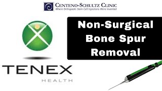 Bone Spur Removal - Non-Surgical Bone Spur Removal Using Tenex