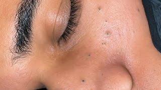 [ASMR] Blackhead Cleansing and Pimple Care Skincare Routine