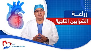 جراحة زراعة الشرايين التاجية  | الدكتور اسامة عباس