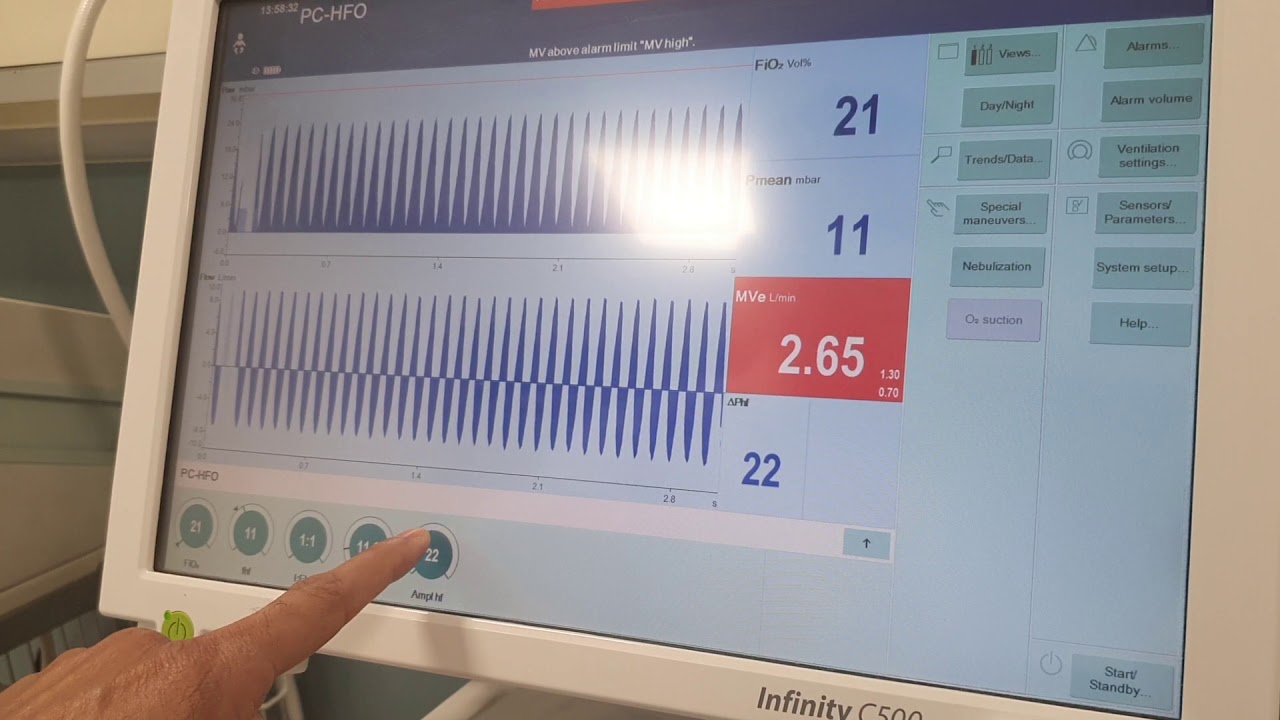 High frequency ventilation chit chat 2