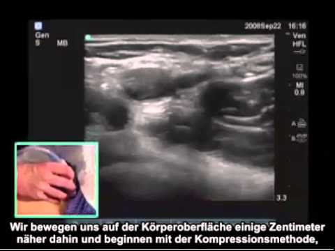 Video: Femoral Venetrombose: Symptomer, Behandling Og Mer