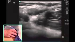 Anleitung: Tiefe Venenthrombose der unteren Extremitäten mit Ultraschall screenshot 5