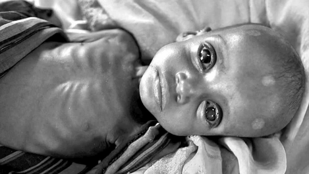 Somalia Famine 2011 - Photos - YouTube