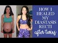 Diastasis Recti Exercises