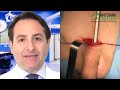 Protesi Pene impianto mini invasivo Andrologo Roma Gabriele Antonini