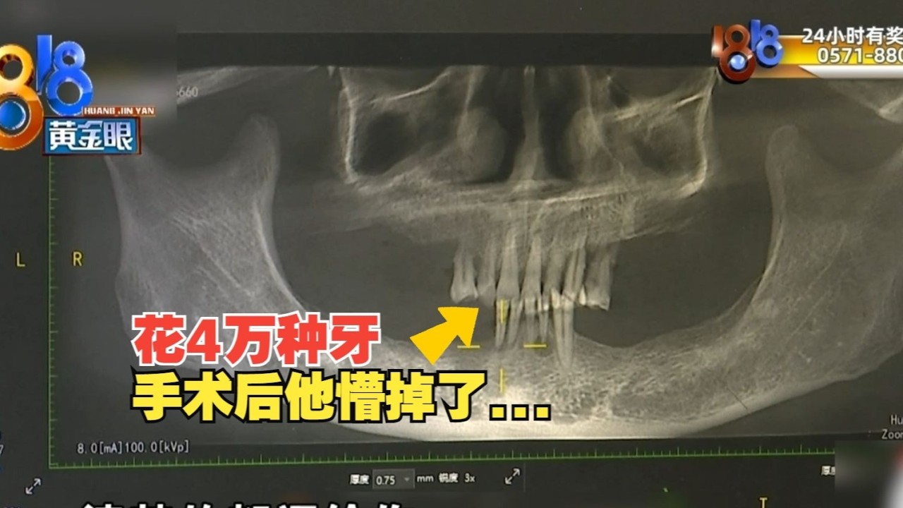 【1818黄金眼】50岁男子“吃东西跟兔子一样”，手术后“懵掉了”