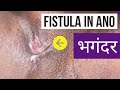 Fistula  bhagandar treatment  live surgery  