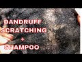 DANDRUFF SCRATCHING with sound and Relaxing Hair Wash