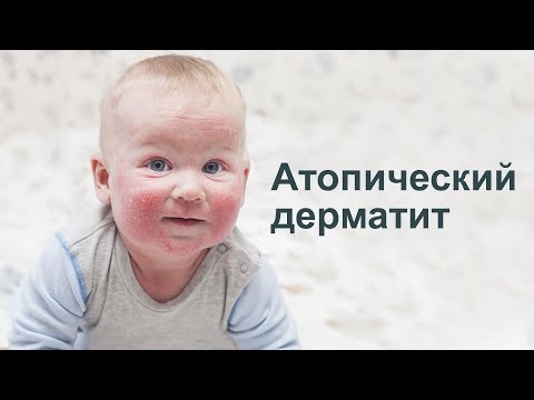 Атопический  дерматит : Аллерголог, Иммунолог Парвиз Азизов