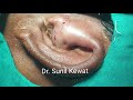 #138 Preauricular Sinus Abscess | Incision and Drainage