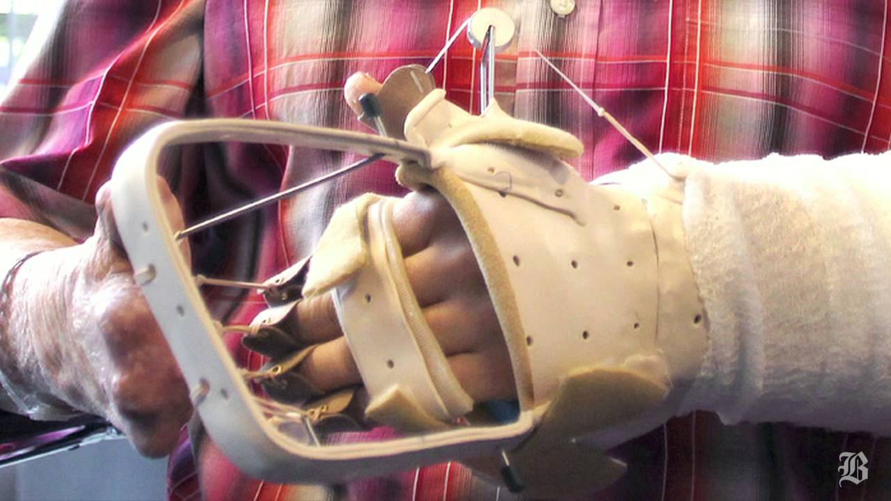 Nightclub survivor leaves hospital after hand transplant