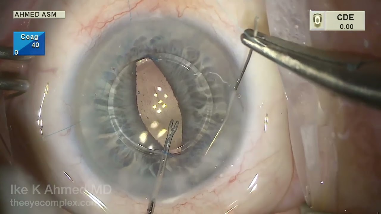 Iris Sutured Intraocular Lens Approach
