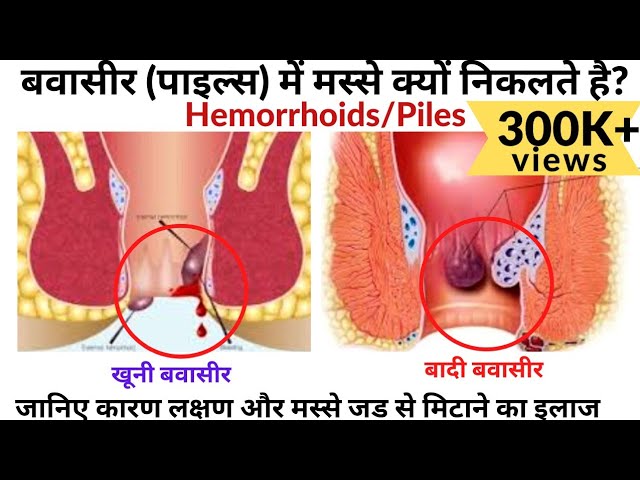 बवासीर पाइल्स क्यो होता है? बवासीर के मस्से ठीक करनेका उपाय|Bawasir Ka Ilaj|Piles Ka Ilaj|Hemorrhoid | NishaMadhurima Recipes