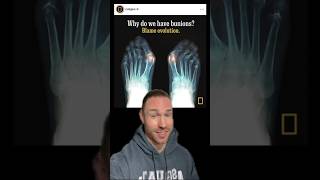 The Truth About Bunions!🤯