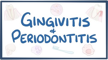 Gingivitis and periodontitis - causes, symptoms, diagnosis, treatment, pathology