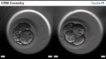 IVF - Embryoscope - 2 Embryos
