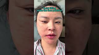 Face lifting, wrinkle removal and firming, youthful appearance#整形#变美#Facelift