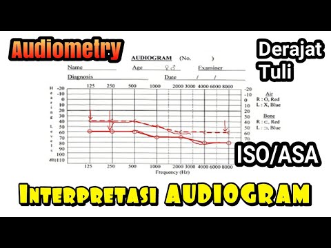 Audiometry dan Interpretasi Audiogram Tuli konduktif sensorineural, campuran ringan sedang berat