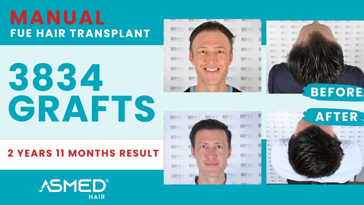 ASMED – Dr. Koray Erdogan – 3834 Grafts | 2 Years 11 Months Results