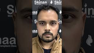 Full Hair Transplant Journey Of A Patient At Skinaa Clinicshorts 