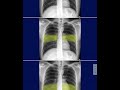 شرح محاضرة Chest Radiology (الجزء الثالث)