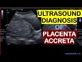 Ultrasound diagnosis of placenta accreta