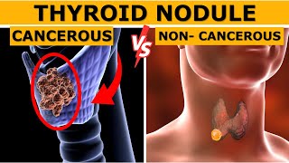 Cancerous vs Non cancerous Thyroid Nodules : How to Tell the Difference? | Dr. Gaurav Gangwani