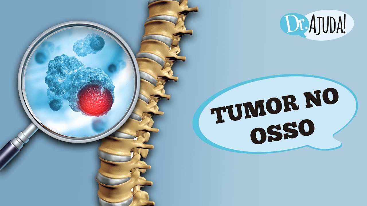 TUMOR NO OSSO O QUE PODE SER? SINTOMAS, DIAGNÓSTICO E TRATAMENTO YouTube TUMOR NO OSSO O QUE PODE SER? SINTOMAS, DIAGNÓSTICO E TRATAMENTO YouTube