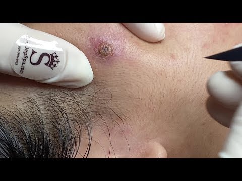 Many Big Acne | Nhiều Mụn Siêu To - SacDepSpa#56