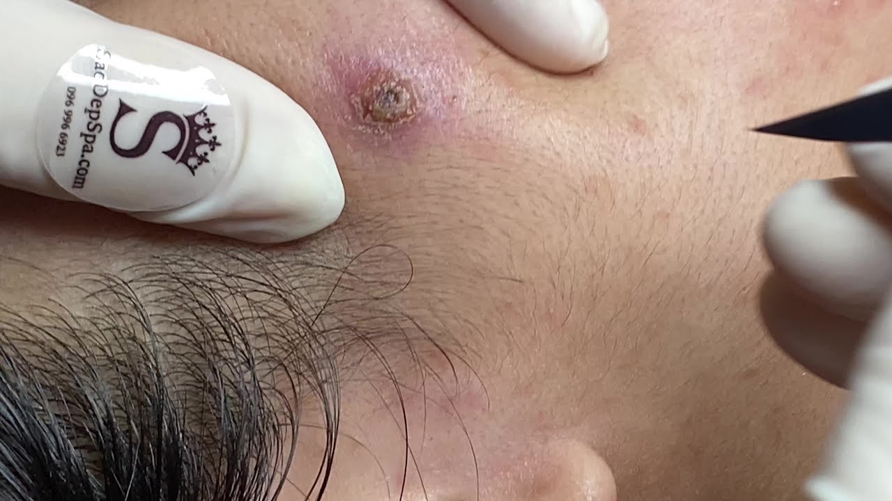Deep Blackheads Removal From Cheeks And Nose Best Pimple Popping Videos Part 32 Youtube