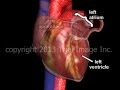 Atrial Fibrillation and Stroke video - Animation and Narration by Cal Shipley, M.D.