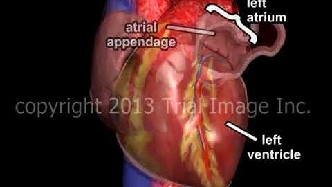 Atrial Fibrillation and Stroke video - Animation and Narration by Cal Shipley, M.D.
