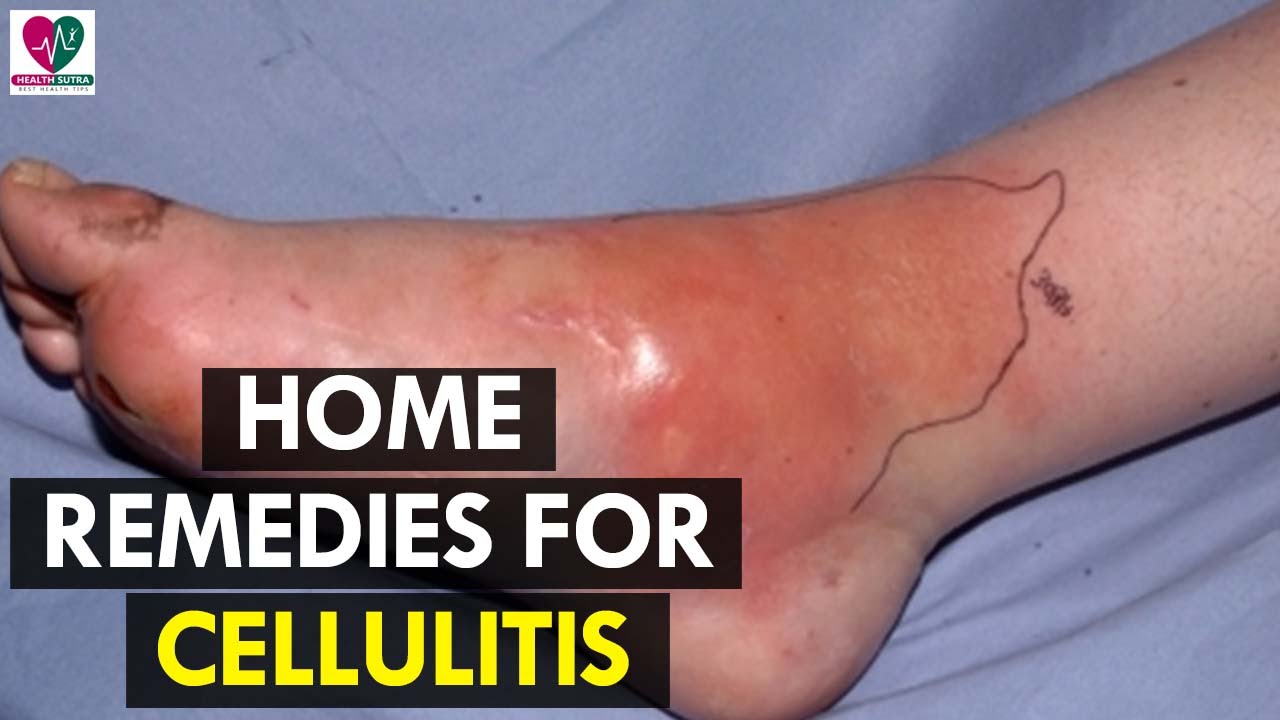 cellulitis home treatment