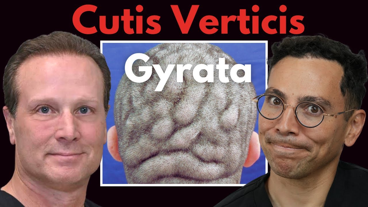 What is Cutis Verticis Gyrata (CVG) | Rare Scalp Condition