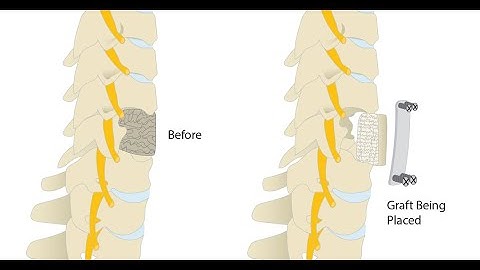 Vertebral corpectomy CPT code - simplify medical coding