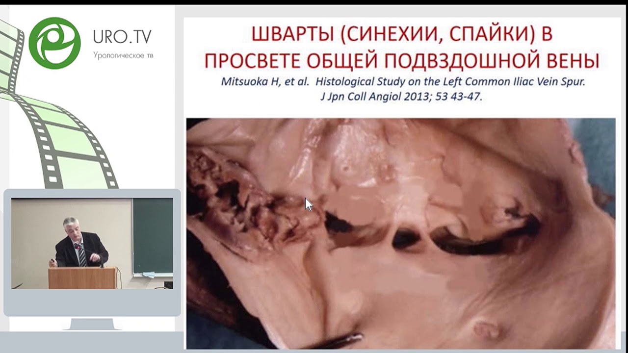 Двустороннее варикоцеле и варикозная болезнь вен органов малого таза ...