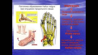 видео Варусная деформация стопы