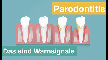 Was tun bei Zahnverlust durch Parodontose?