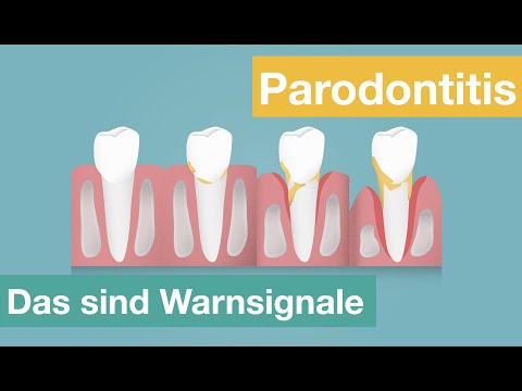 Video: Wie man geschwollenes Zahnfleisch reduziert (mit Bildern)