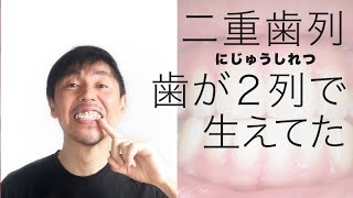 二重歯列を抜いたらどうなった 重なってる歯は安易に抜くな Youtube 二重歯列を抜いたらどうなった 重なってる歯は安易に抜くな Youtube