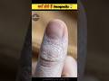 Finger में Hangnails क्यों होते हैं 😱 #finger #shorts #facts #viral #amazing #health #information