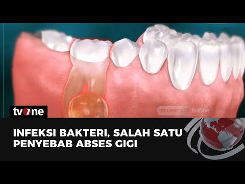 Video: Adakah abses gigi biasa?