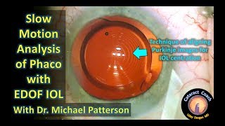 Slow Motion Analysis of Cataract Surgery with EDOF IOL