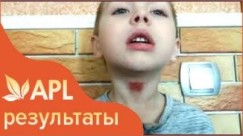 Очищение кожи после приема леденцов APL  APLGO результаты  Клеточное питание APL