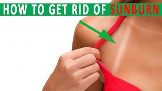 How to get rid of Sunburns | 5 Home remedies